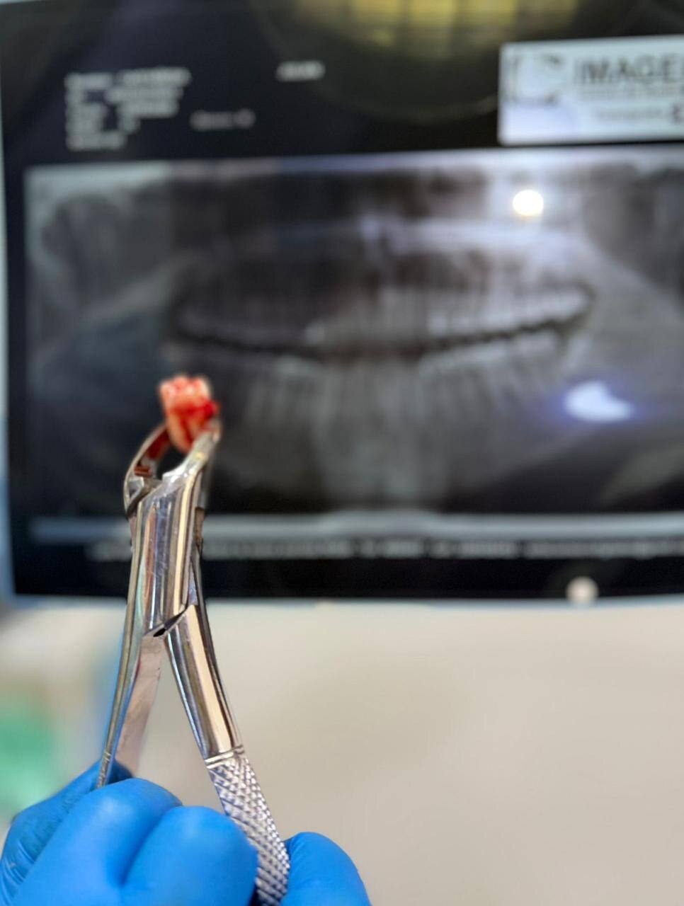 Instrumental utilizado en una extracción dental frente a una radiografía panorámica