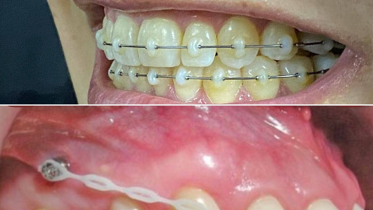 Composición de dos fotografías clínicas de tratamientos de ortodoncia