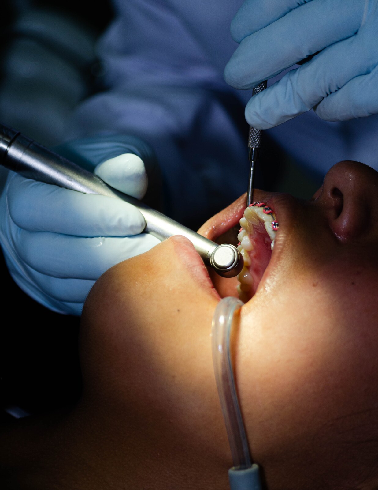 Primer plano de un procedimiento de ortodoncia realizado con instrumental clínico